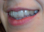 Teeth with Invisalign tray